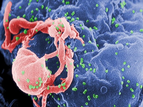 Istoričar otkrio kako je zapravo počela epidemija AIDS-a