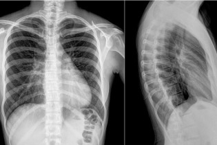 Borba protiv tuberkuloze: Slab imunološki sistem krivac za razvijanje TBC-a