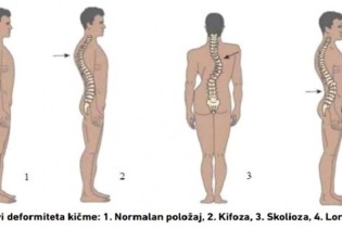 Sve izraženiji deformiteti lokomotornog sistema kod školaraca