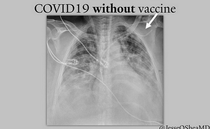 Covid pluća s vakcinom i bez primljene vakcine