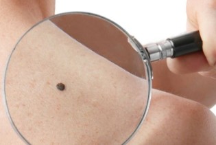 Euromelanoma: Građani Sarajeva na više lokacija će u toku maja imati preglede