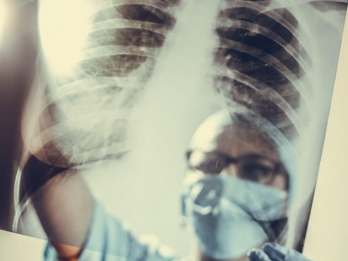 Nova nada za oboljele: Hoće li se KOPB moći liječiti transplantacijom vlastitih plućnih stanica?