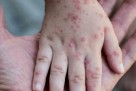 WHO upozorava: Prijeti epidemija majmunskih boginja