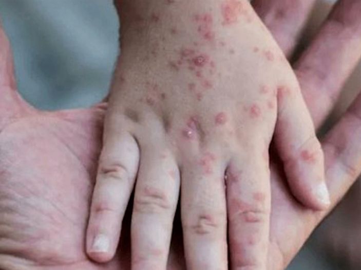 WHO upozorava: Prijeti epidemija majmunskih boginja