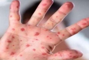 Na području Kantona Sarajevo proglašena epidemija morbila