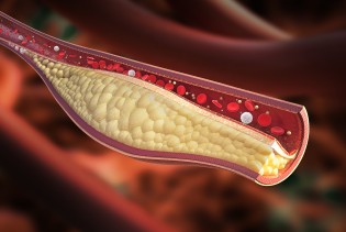 Četiri vrste holesterola koje utječu na zdravlje srca