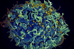 Naučnici uspješno uklonili HIV iz zaraženih ćelija