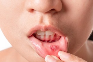 Afte: Uobičajne, ali neugodne ranice u ustima