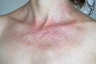 Alergija na sunce: Simptomi, prevencija i savjeti za njegu kože