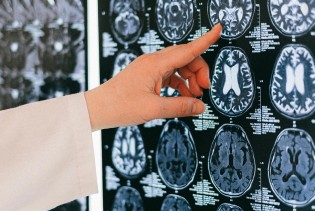 Alzheimerova bolest češća među radno sposobnim ljudima