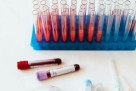 Ugrušak u tijelu? Test koji ga odmah razotkriva