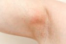 Gnojni hidradenitis nije samo estetski problem - kako ga liječiti?