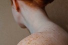 Dobili ste pjege tokom vrućina? Tinea versicolor – gljivična infekcija ljeta
