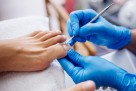 Prirodni načini za uklanjanje kurjeg oka: recepti koje možete isprobati kod kuće