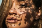 Kako prirodno zaustaviti herpes na usnama?