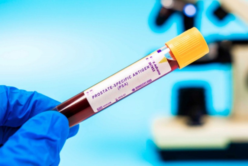 Novi AI alat skraćuje čekanje na dijagnozu raka prostate