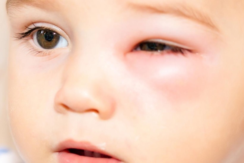 Periorbitalni celulitis: Infekcija koja najčešće pogađa djecu