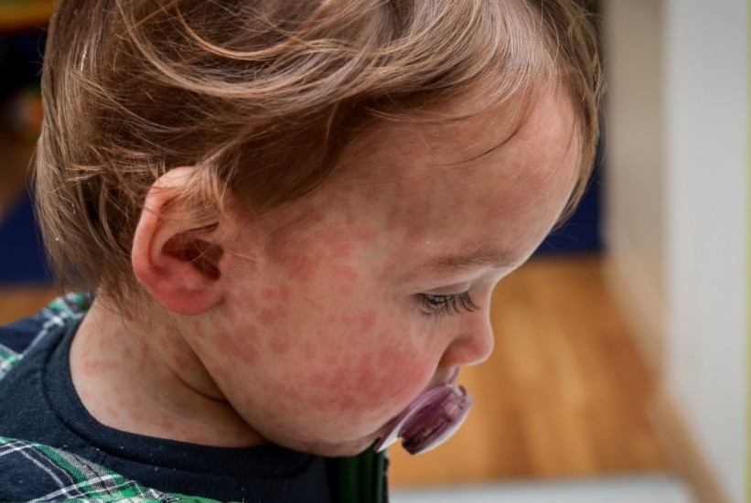 Najzarazniji dječiji virus ponovo raste: Evo kako spriječiti komplikacije