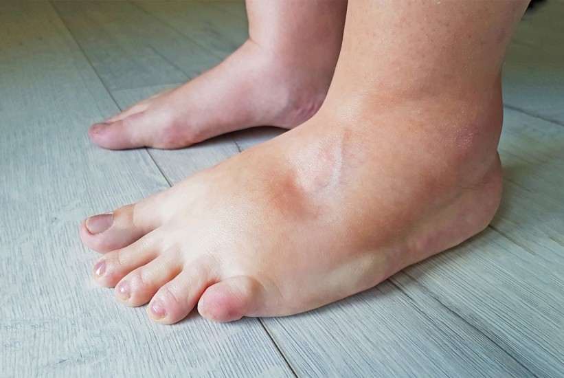 Stopala koja otiču mogu upozoravati na bolest ili ugruške