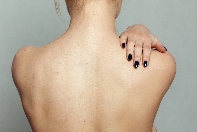 Savršena leđa bez akni: Vodič kroz zdravu ishranu!