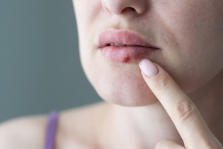 Koliko traje herpes i kada konačno niste opasni za druge?