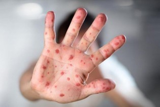 Porast morbila u Evropi: Vakcinacija ključna za zaustavljanje bolesti