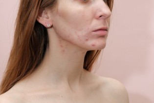 Kako prepoznati hormonski disbalans i zašto ga ne treba ignorisati