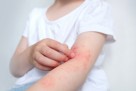 Kada svaki dodir peče: Kako prepoznati atopijski dermatitis kod djece