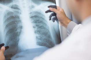 Nova nada za oboljele od raka pluća: Eksperimentalni lijek pokazao ohrabrujuće rezultate