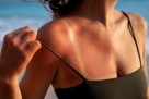 Izgorjeli ste na suncu? Dermatolozi daju korisne savjete