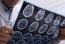 Napredak u borbi protiv multiple skleroze: AI otkrio promjene koje su godinama bile nevidljive