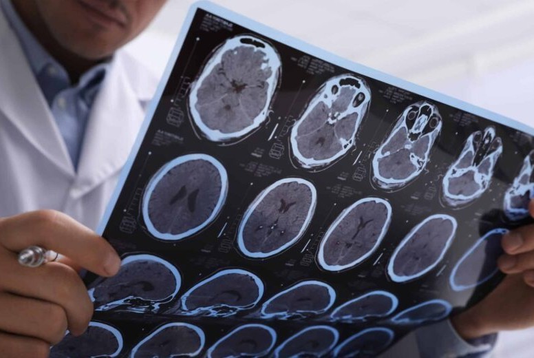 Napredak u borbi protiv multiple skleroze: AI otkrio promjene koje su godinama bile nevidljive