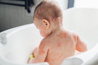 Osip kod djece zabrine roditelje, ali ne mora biti atopijski dermatitis