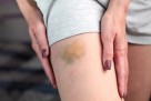 Modrice vam se pojavljuju niotkuda? Ovo su situacije kada ih ne treba ignorisati