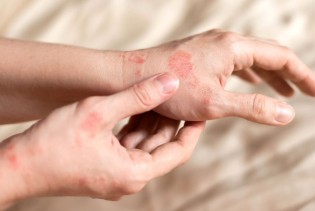 Svjetski dan psorijaze: Bolest kože koja nije zarazna, ali može ozbiljno utjecati na život